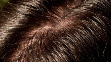 درمان چربی مو در طب سنتی