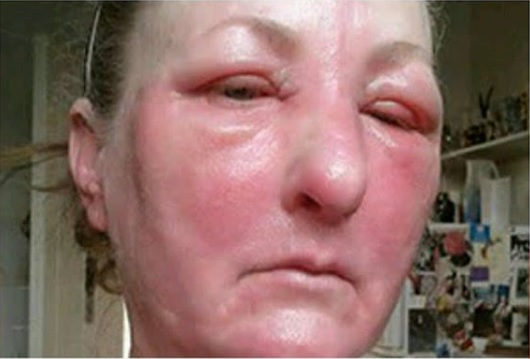 درمان ورم صورت با هندوانه