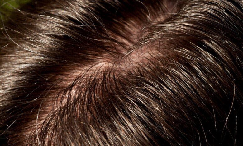 درمان چربی مو در طب سنتی